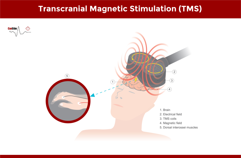 an illustration of TMS with a patient lying down and the TMS coil placed on the head